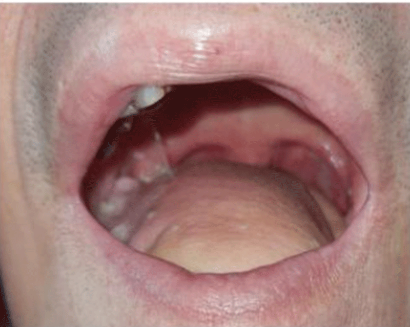 Tái tạo khuyết hổng lưỡi, nhằm giúp bệnh nhân phục hồi chức năng của lưỡi sau điều trị ung thư