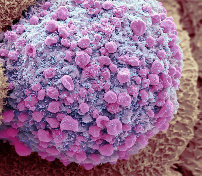 Hé lộ nguyên nhân gây ra tình trạng hậu COVID