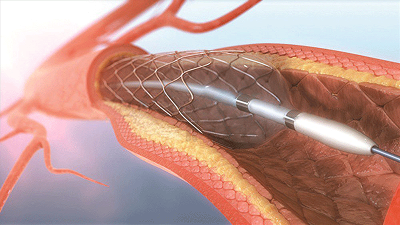 Stent mạch vành phủ thuốc đầu tiên sản xuất tại Việt Nam