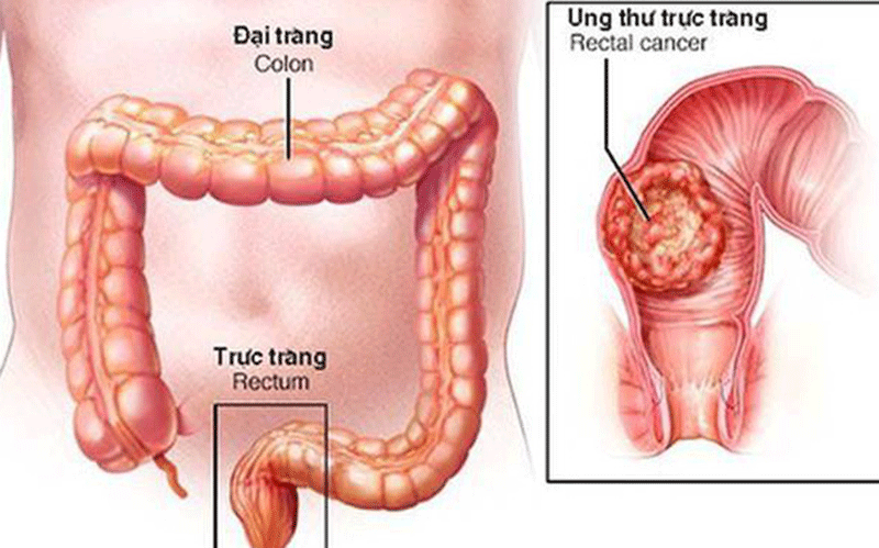 Công nghệ giải trình tự gene mới giúp phát hiện sớm ung thư đại trực tràng