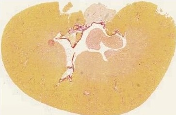 Loại thuốc cũ mang lại triển vọng mới trong việc điều trị bệnh thận phổ biến