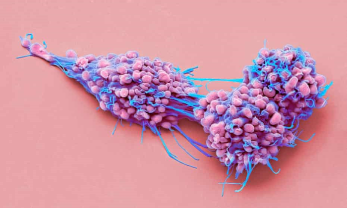 Hai loại thuốc mới giúp ngăn chặn sự phát triển của khối u buồng trứng