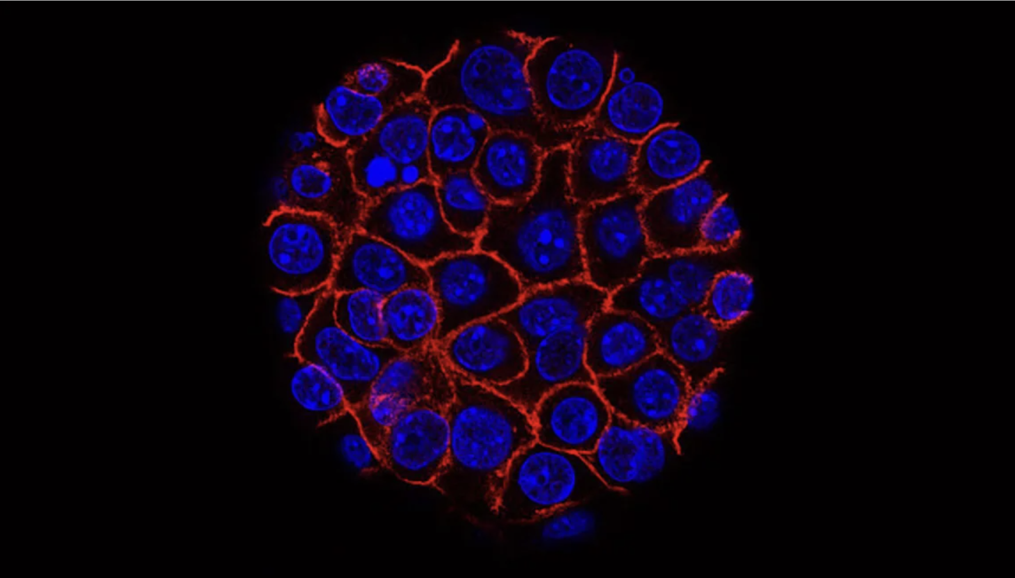 Phát triển các phương pháp giúp phát hiện sớm ung thư tuyến tụy