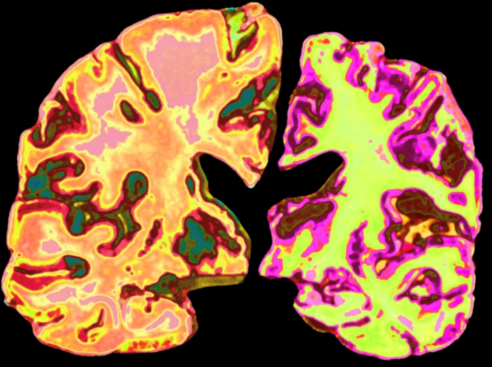 Hy vọng mới cho bệnh Alzheimer: Lithium đảo ngược mất trí nhớ ở chuột