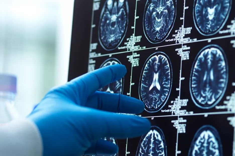 Lần đầu tiên trực tiếp quan sát được ‘yếu tố kích hoạt’ bệnh Parkinson trong mô não người