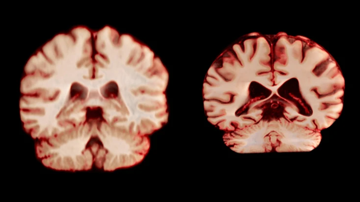 Phụ nữ có nguy cơ mắc Alzheimer cao hơn nam giới, dù não bộ lão hóa chậm hơn