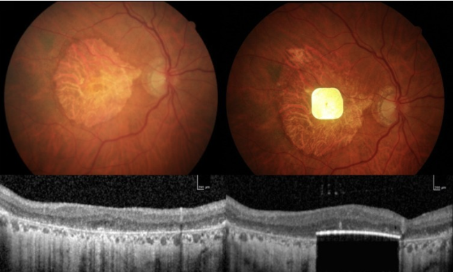 Người mù lấy lại được thị lực nhờ cấy ghép võng mạc nhân tạo