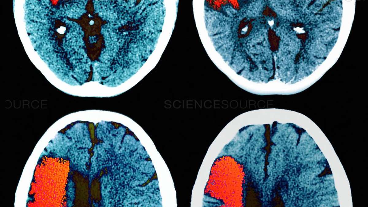 Đột quỵ và mất trí nhớ: chiến đấu với sự mất mát chức năng trong các mạch máu não nhỏ